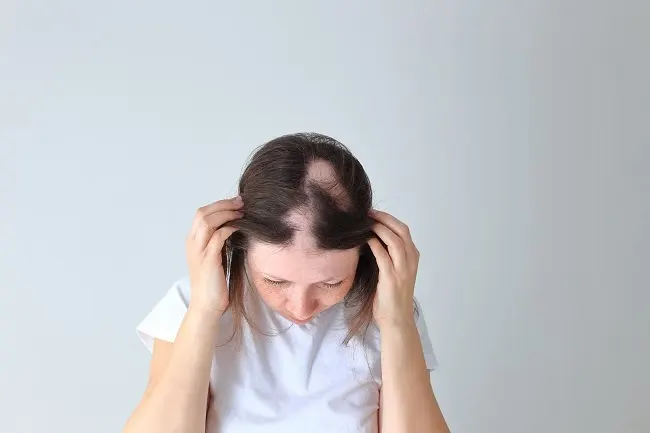 kebotakan pada rambut