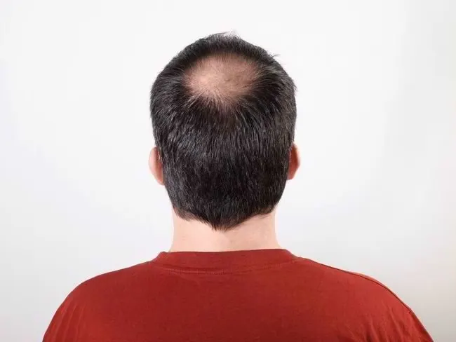 rambut botak parah