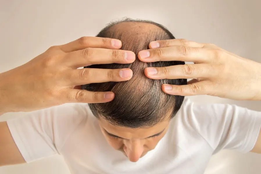 kebotakan rambut