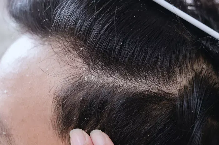 rambut berketombe