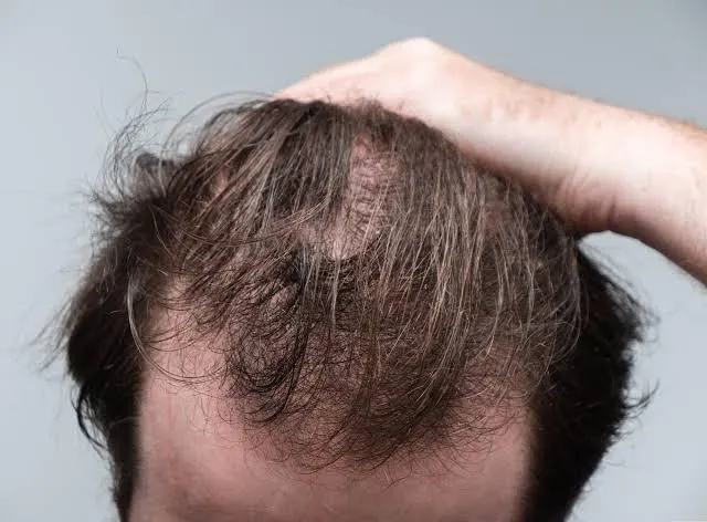 Telogen Effluvium