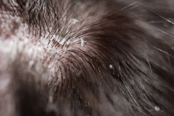 Dandruff Hair Problems of a Young Man shot with a macro