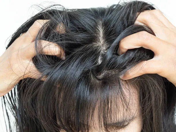 infeksi jamur pada rambut