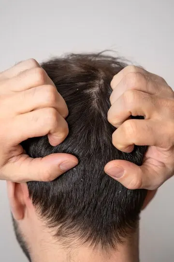 6 Perawatan Alami untuk Menghilangkan Ketombe Secara Efektif