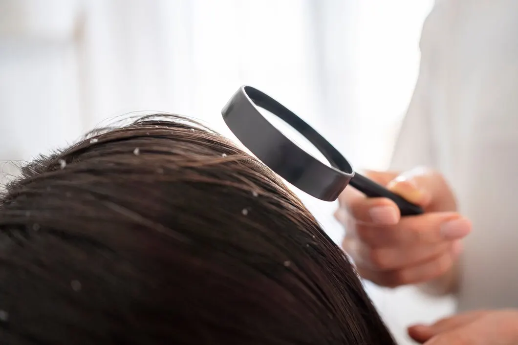 Resep Masker Rambut Alami untuk Mengatasi Ketombe