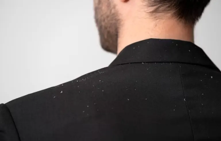 Kebiasaan yang Harus Dihindari Agar Rambut Bebas Ketombe