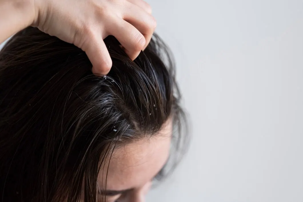 Mitos atau Fakta: Ketombe Bisa Menular?