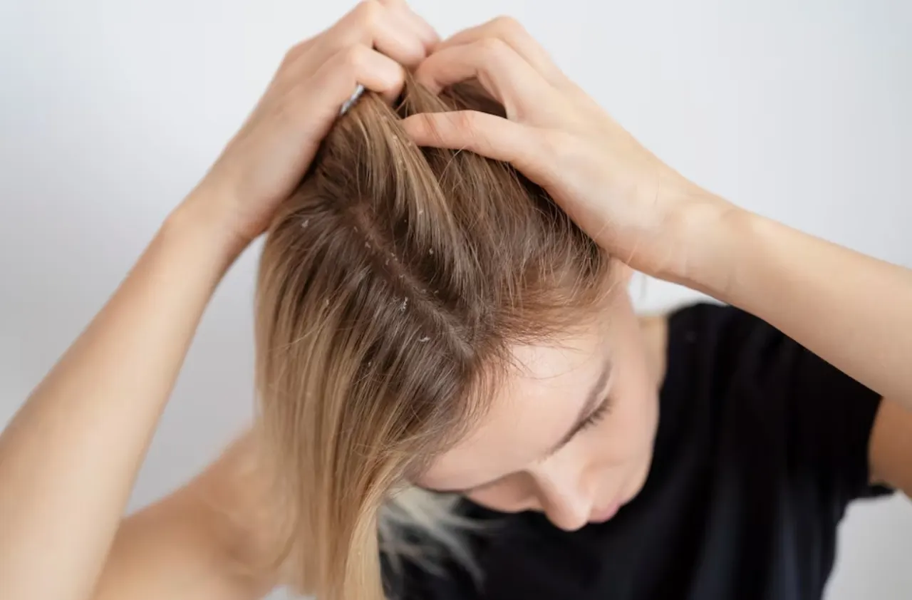 Apakah Ketombe Bisa Menyebabkan Rambut Rontok? Ini Penjelasannya
