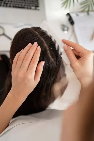 Cara Menghindari Ketombe pada Rambut Anda: Tips Sederhana untuk Rambut yang Lebih Sehat