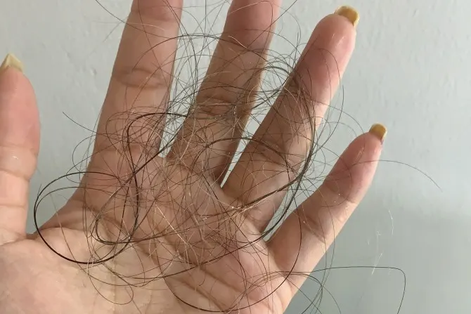 Rambut Rontok karena Sering Catok atau Smoothing? Begini Cara Mencegahnya