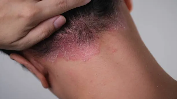 kulit kepala dermatitis seboroik