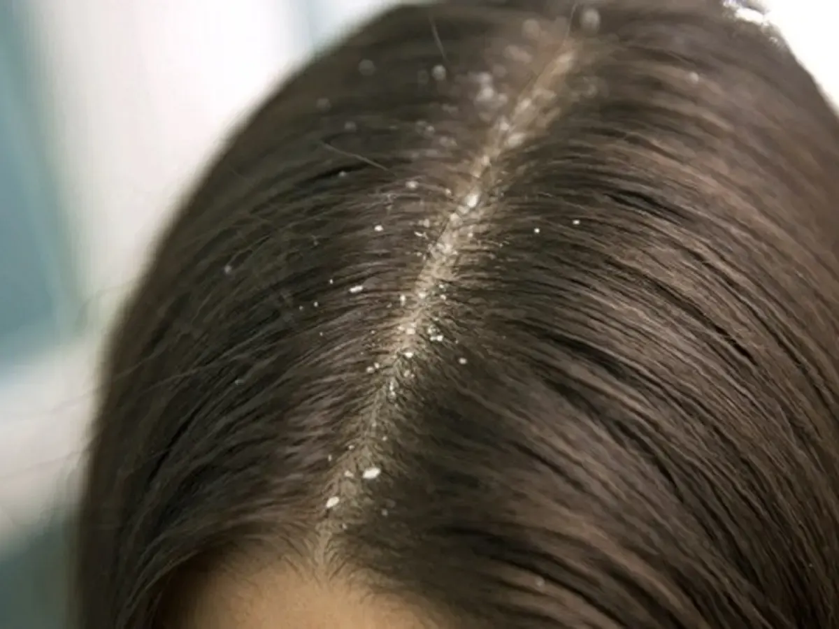 Ritual Perawatan Kulit Kepala untuk Mencegah Ketombe dan Menjaga Rambut Tetap Sehat