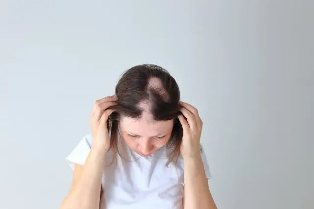 12 Tips Efektif Mencegah Kebotakan Rambut yang Perlu Diketahui