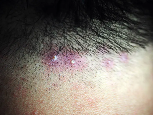 10 Tips Mengatasi Folikulitis, Rambut Meradang yang Disebabkan Virus