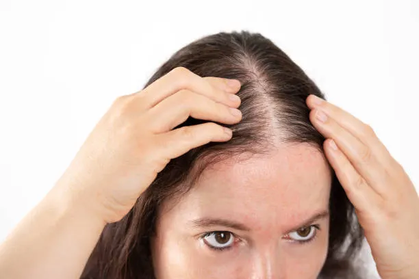 15 Tips Mengatasi Penipisan Rambut di Garis Rambut yang Ganggu Penampilan