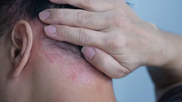 Tips Mengatasi Eksim di Kulit Kepala, Kenali Juga Penyebab dan Gejalanya