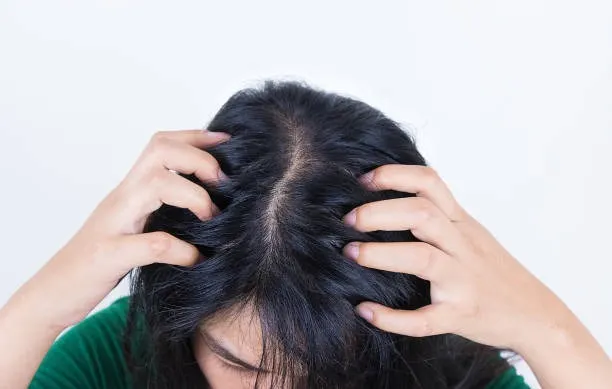Keringnya Kulit Kepala karena Produk Rambut yang “Terlalu” Keras