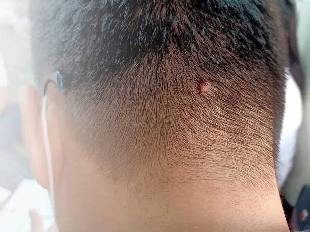 Kutil di Kulit Kepala: Ngeselin Banget, Tapi Tenang Ada Jalan Keluarnya!