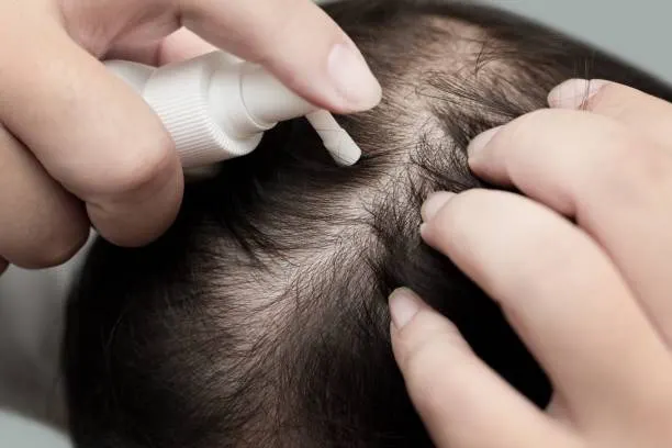 Rambut Tipis? Nggak Masalah! Begini Cara Bikin Semakin Tebal