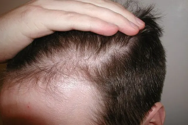 Cara Mencegah Uban Dini dan Menjaga Kesehatan Rambut