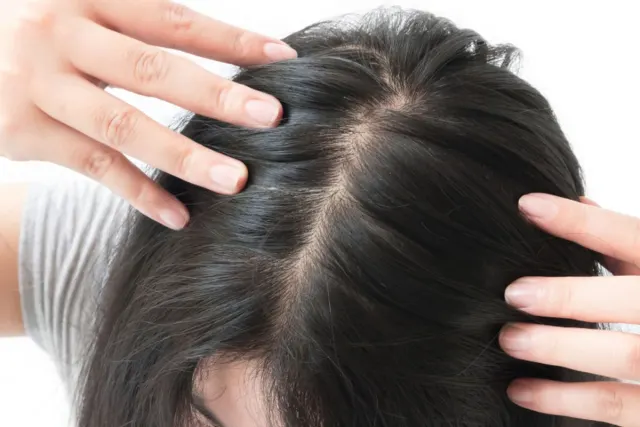 Mengapa Sampo Anti-Ketombe Tidak Selalu Cukup? Coba Cara Ini Agar Ketombe Hilang Total!