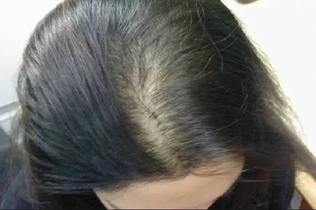 Transplantasi Rambut: Prosedur, Biaya, dan Risiko yang Perlu Kamu Tahu