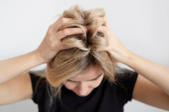 7 Kebiasaan Sepele yang Diam-diam Merusak Kulit Kepala Kamu