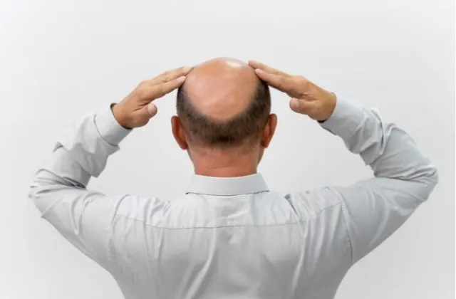 Fakta atau Mitos: Benarkah Vitamin Rambut Bisa Mengatasi Kebotakan?