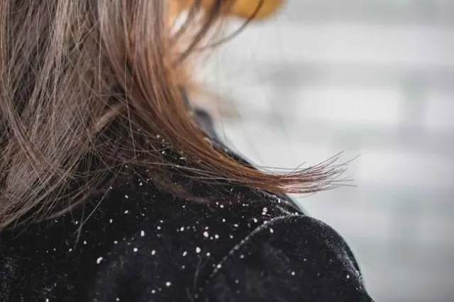 Penyebab Rambut Berketombe yang Paling Sering Diabaikan