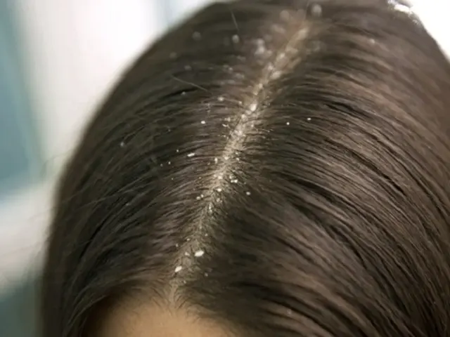 Ritual Perawatan Kulit Kepala untuk Mencegah Ketombe dan Menjaga Rambut Tetap Sehat