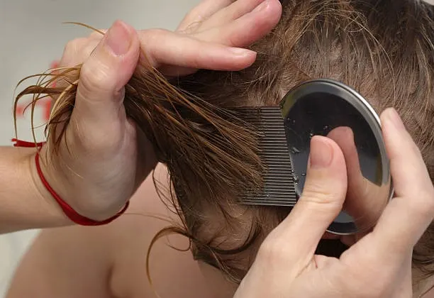 Kutu Rambut: Penyebab, Dampak, dan Cara Efektif Mengatasinya