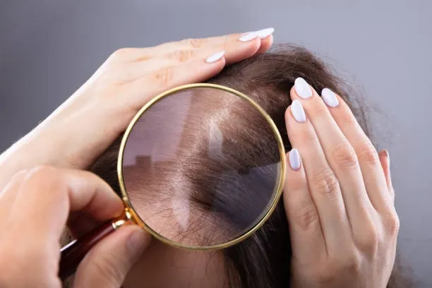 Perawatan Laser untuk Rambut Rontok: Mitos atau Fakta? Simak Penjelasan Lengkapnya