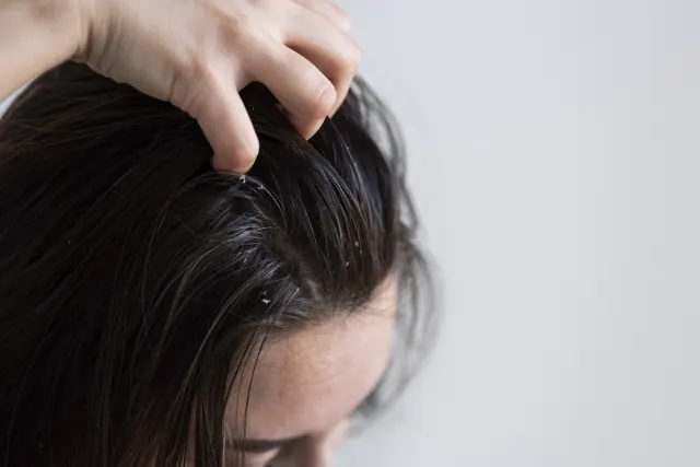 11 Cara Alami Mengatasi Rambut Rontok yang Ampuh dan Mudah
