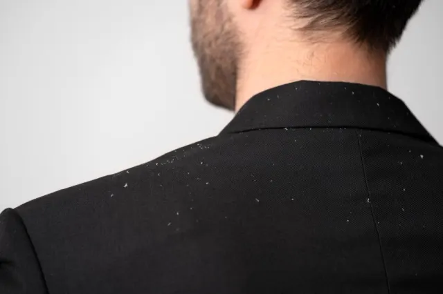 11 Cara Mencegah Rambut Rontok yang Ampuh dan Mudah Dilakukan